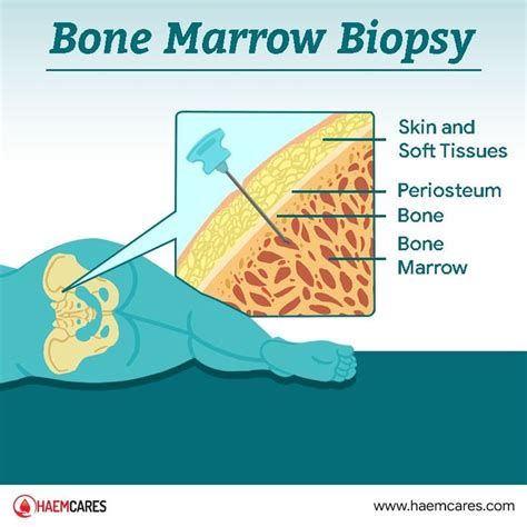 Pin on Bone marrow test