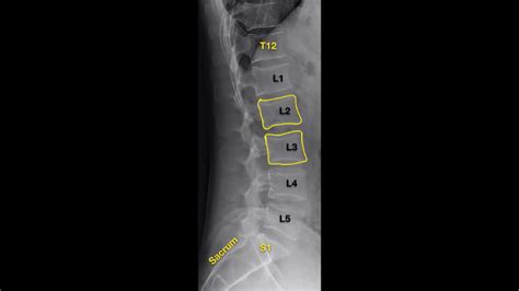 Lumbar X-ray Interpretation - OSCE Guide | Radiology | Geeky Medics