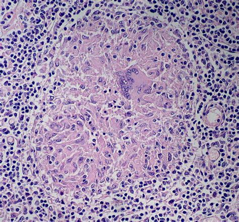 Caseating Granuloma Histology