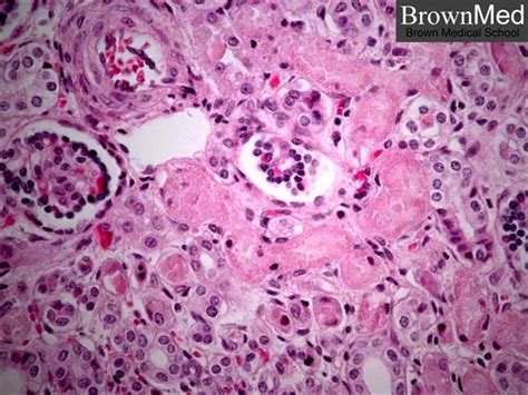 Pathology Outlines - Acute tubular necrosis (ATN)