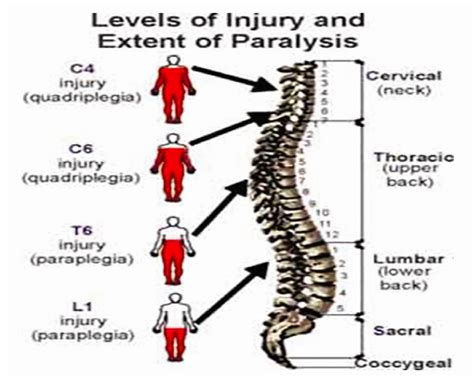 Quadriplegia Tetraplegia Definition Causes Symptoms