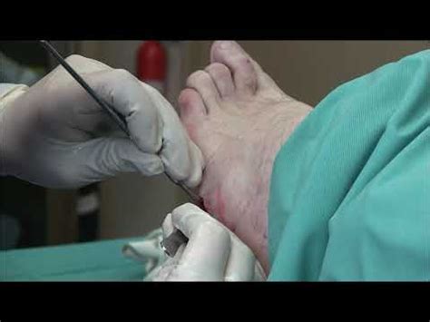 Plantar Fibroma Pictures Treatment Surgery Symptoms