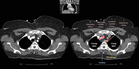 Chest anatomy - Radiology Cafe