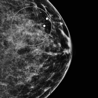 Craniocaudal mammogram image demonstrates central radiolucency without ...