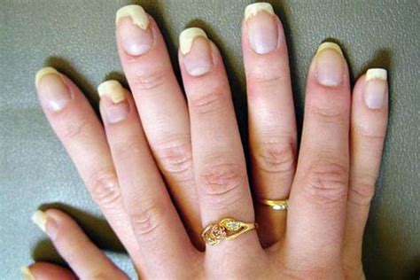 7 Symptoms To Spot The Nail Fungus Before it Harms