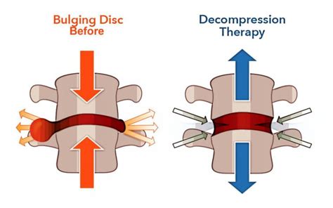 Do You Have a Herniated Disc or Sciatica? Try Spinal Decompression Therapy: Elite Spine and ...