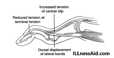 SWAN NECK DEFORMITY: CAUSES, TREATMENT - ILLnessAid