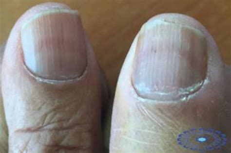 Discover 117+ discolored nails and kidney disease - ceg.edu.vn