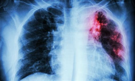 How our lungs 'remember' a Covid-19 infection • healthcare-in-europe.com