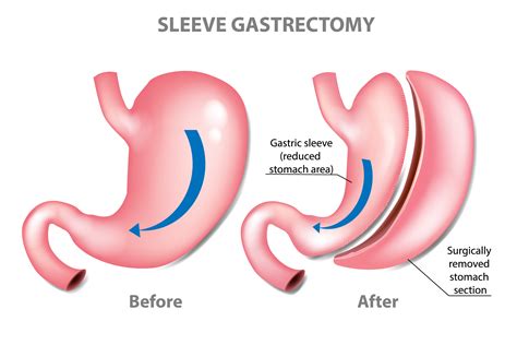 The honest truth about gastric sleeve surgery | Nashville Weight Loss Solutions