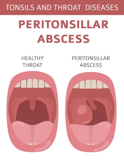 What is this Painful Throat Abscess?