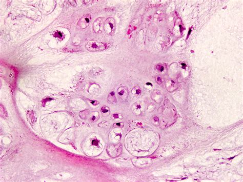 Pathology Outlines - Synovial & tenosynovial chondromatosis