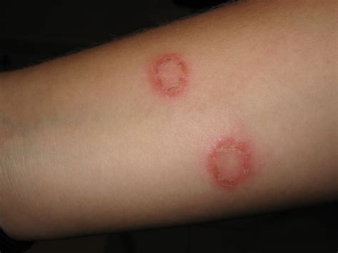 Veterinary Blog from Dr. Martell: What are these itchy circles on my skin?