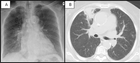 The Cuffing Of Lungs