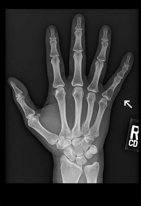 OrthoDx: Injury to Pinky Finger - Clinical Advisor