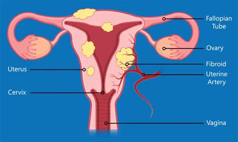 What is a Myomectomy?