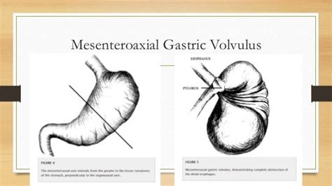 Pediatric Gastric Volvulus