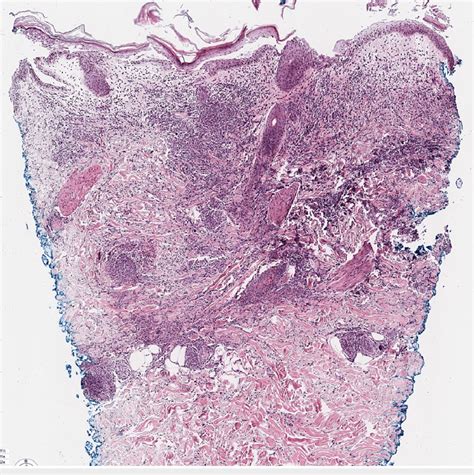 Punch biopsy specimen from lesion on the anterior thigh (H&E 4x). There ...