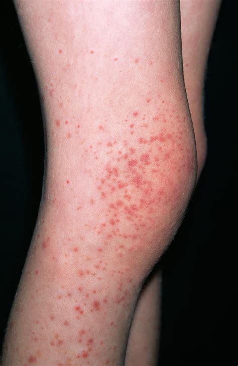 Purpura Rash Photograph by Dr P. Marazzi/science Photo Library