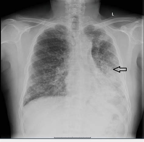 Chest x-ray posteroanterior view shows extensive patchy-toconfluent... | Download Scientific Diagram