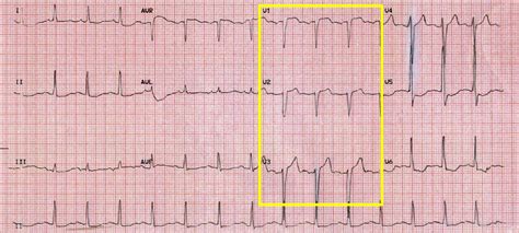 Suspected ST segment elevation myocardial infarction referred for primary angioplasty: a ...