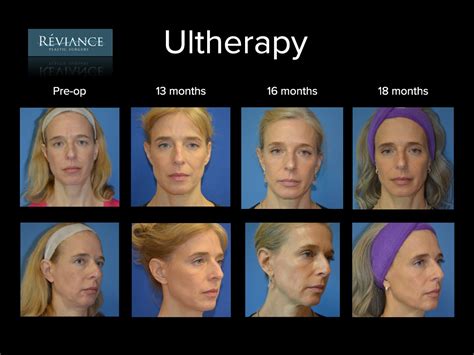 Ultherapy: A Safe And Effective Face Lift Procedure | Justinboey