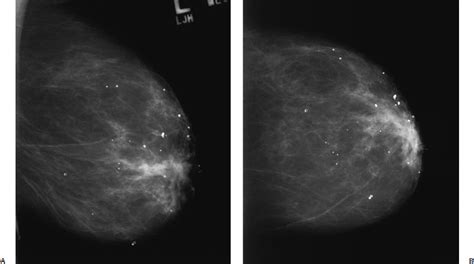 Focal Asymmetry | Radiology Key