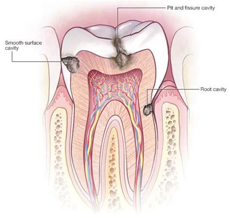 Cavity - Smile Dental Hospitals