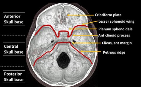 Figure 2 from A quiz about skull base anatomy and pathologies: Make learning fun! | Semantic Scholar