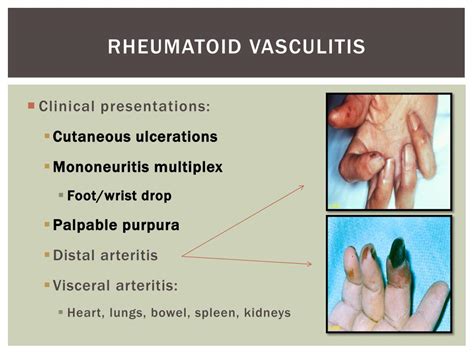 PPT - Rheumatoid Arthritis PowerPoint Presentation, free download - ID ...