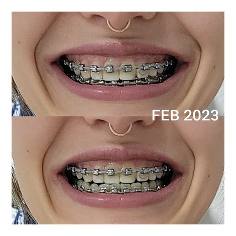 Braces Progress : r/braces