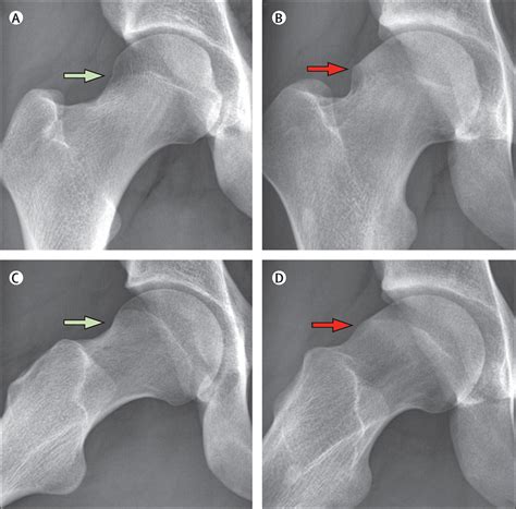 Osteoarthritis - The Lancet