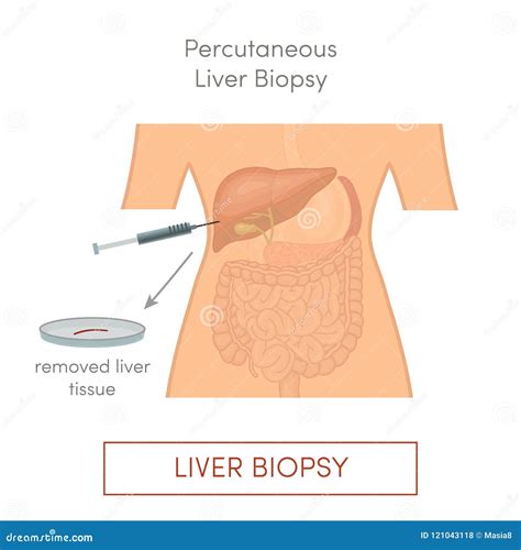 Percutaneous liver biopsy stock illustration. Illustration of disease ...