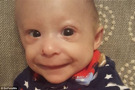 Seven-month-old Kentucky boy who weighs three pounds born with rare form of dwarfism | Daily ...