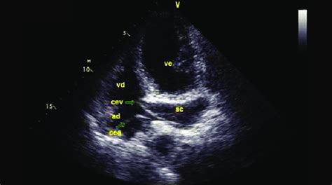 Two-dimensional echocardiogram demonstrating the relationship of the ...