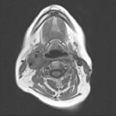 (PDF) Bilateral Carotid Paraganglioma: Surgery and Radiotherapy