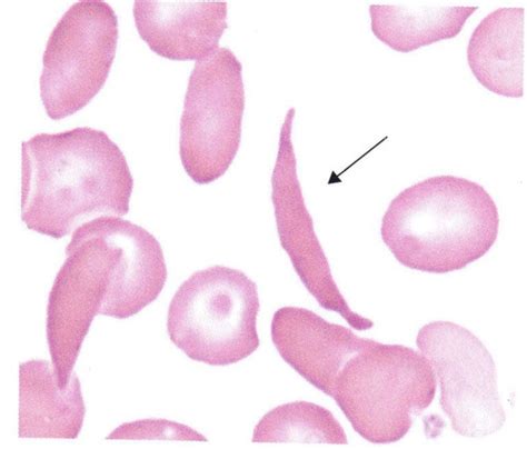 Red Blood Cell Morphology Flashcards | Quizlet