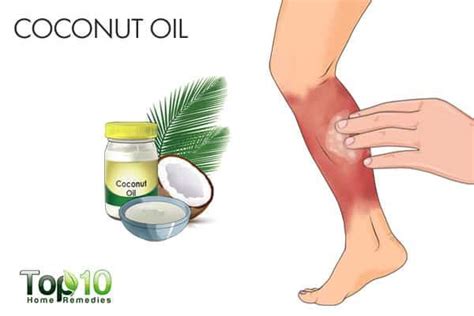 Cellulitis: Home Treatment & How to Prevent It - eMediHealth | Skin infection remedy, Home ...