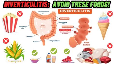 7 Foods To Avoid With Diverticulitis | Diverticulitis Diet | Diverticulitis Foods To Avoid - YouTube