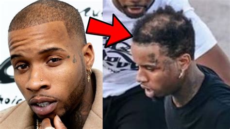 Tory Lanez Hair Transplant | Sapphire Hair Clinic