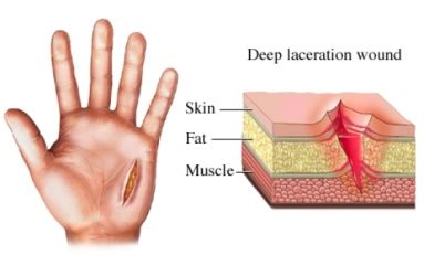 Laceration Wounds & Cuts Treatment in Singapore - Singapore Sports And ...