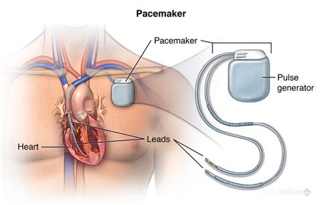 TEMPORARY PACEMAKER - Dr. Rakesh Jain