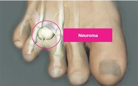 Treatment for Mortons Neuroma | Yorkshire Foot HospitalYorkshire Foot ...