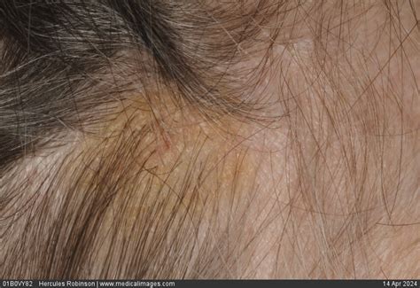 STOCK IMAGE, seborrheic keratosis on the scalp of a 56 year old female patient seborrheic ...