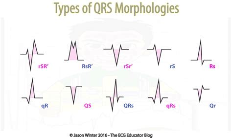 EKG QRS Morphologies #MedStudent #EKG #QRS #Morphologies ... | GrepMed