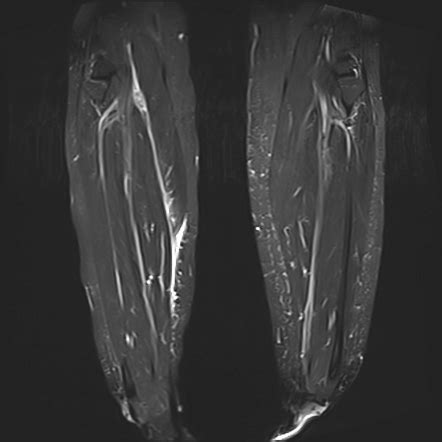 Medial Gastrocnemius Head Tear Grade Image Radiopaedia Org | Hot Sex Picture