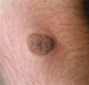 Treatment for Warts – Medical Symptoms Guide