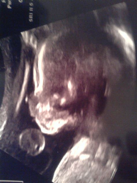 2littleBoonegirls: 22 weeks- Level II ultrasound