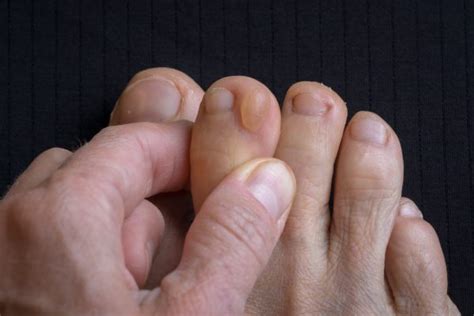 What’s the Difference Between Foot Corns vs Foot Calluses? - Foot and Ankle Group