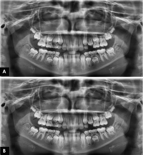 Image quality assessment of pre-processed and post-processed digital panoramic radiographs in ...